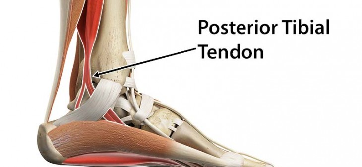 Posterior Tibial Tendon Injury Pain On Inside Of Ankle