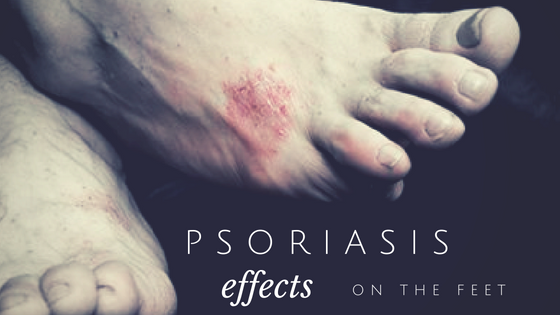 Palmoplantar Psoriasis: Causes, Symptoms, Risks, Treatment