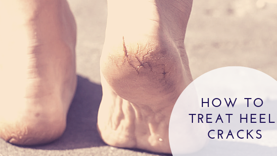 Our Best Tips For Treating & Preventing Cracked Heels