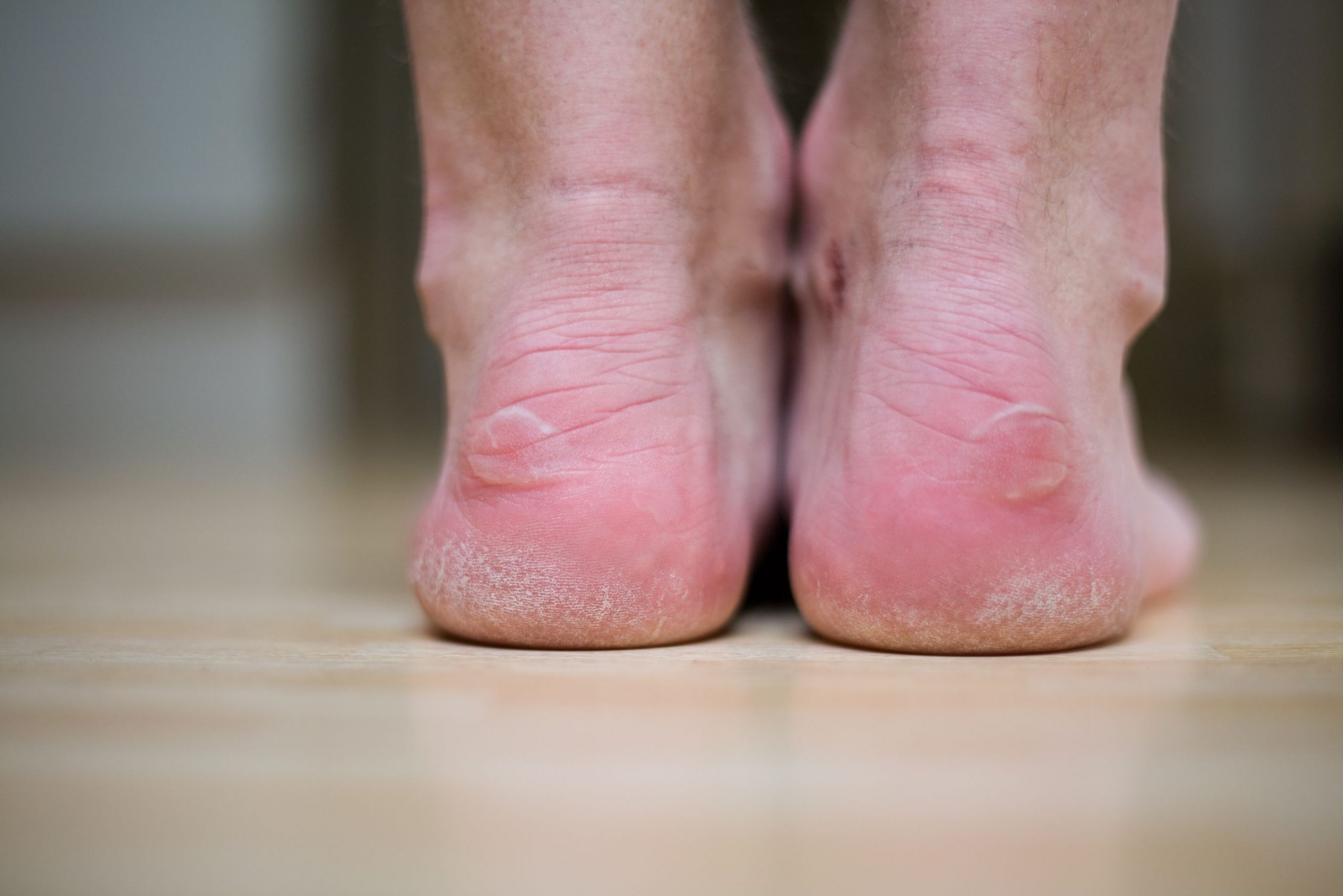 Blisters On Big Toe From Soccer Cleats Design Talk